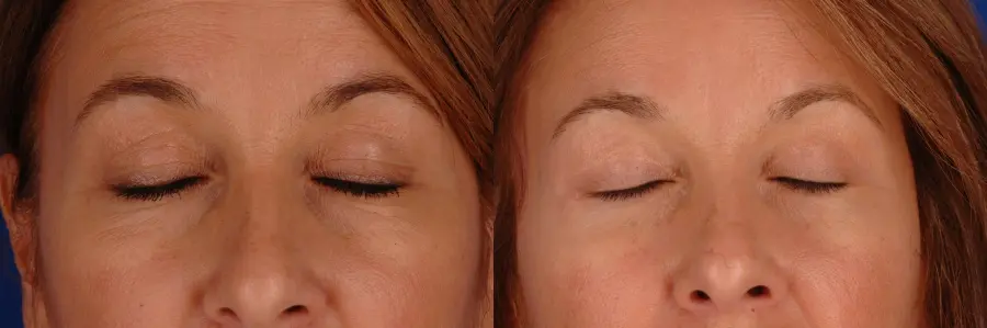 Eyelid Lift Lake Shore Dr, Chicago 2338 - Before and After 2