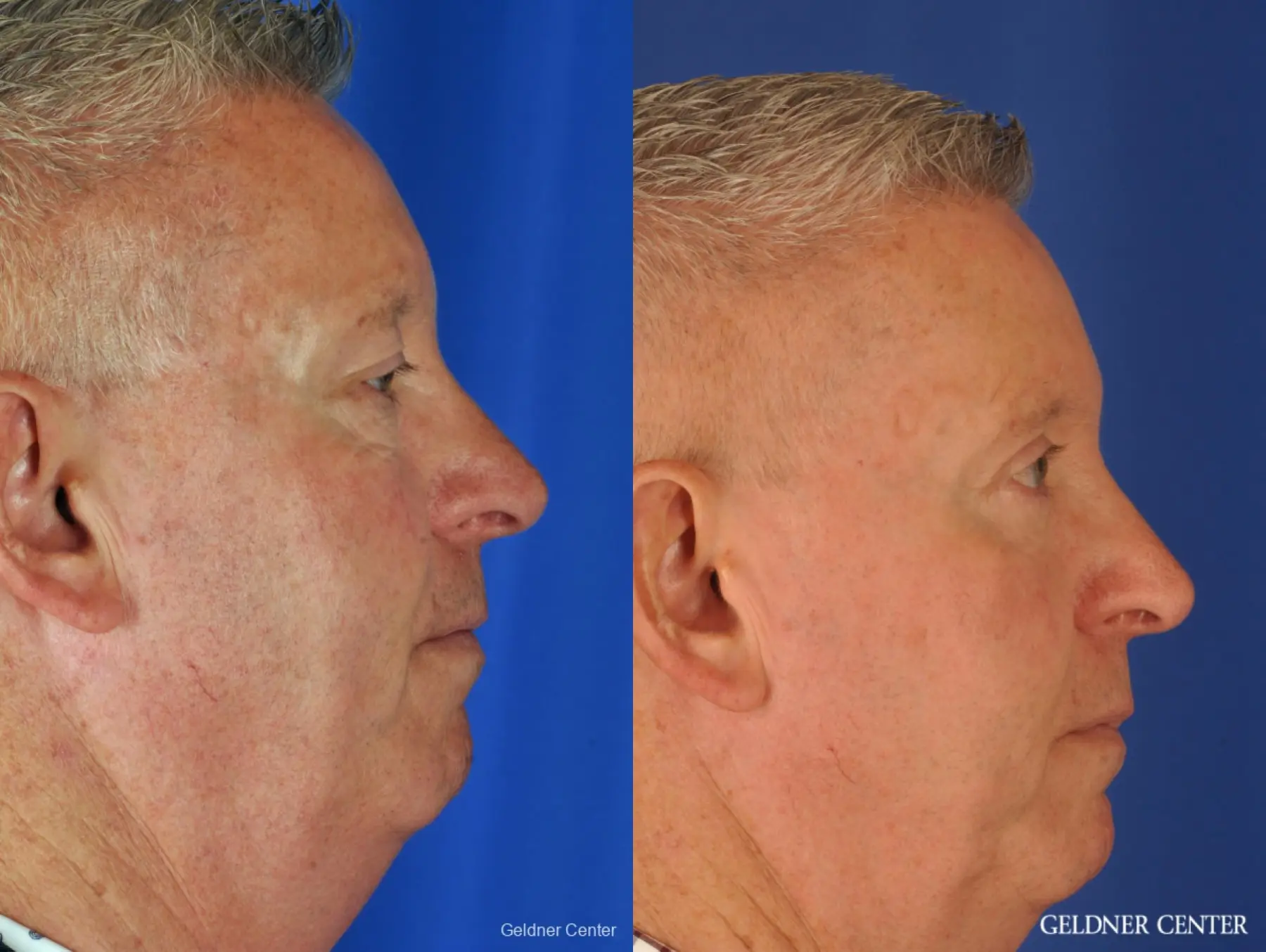 Eyelid Lift For Men: Patient 1 - Before and After 5