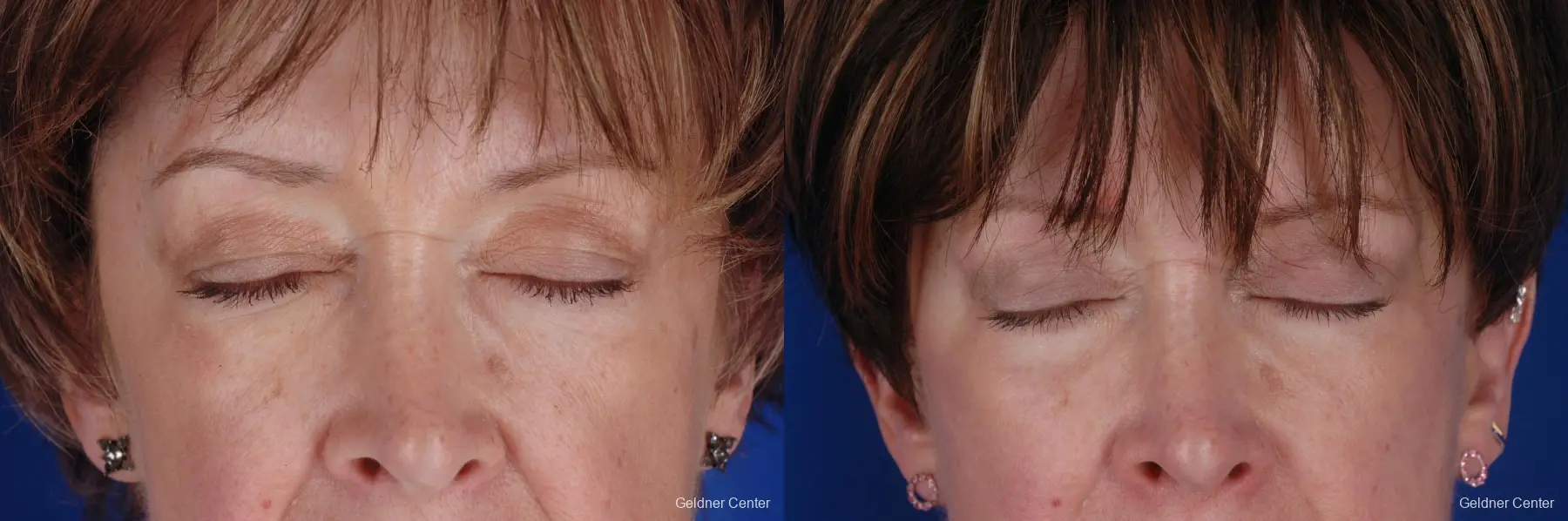 59 year old woman, upper and lower lid blepharoplasty - Before and After 2