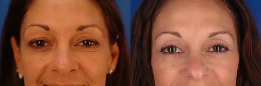 Eyelid Lift Hinsdale, Chicago 2404 - Before and After 1