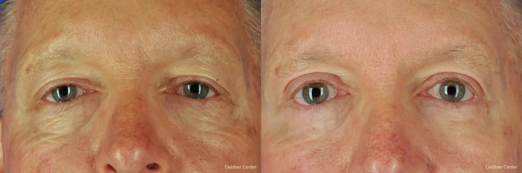 Eyelid Lift For Men: Patient 1 - Before and After 1