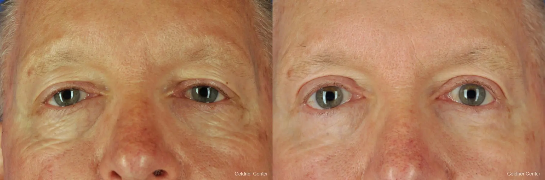 Eyelid-lift-for-men: Patient 2 - Before and After  