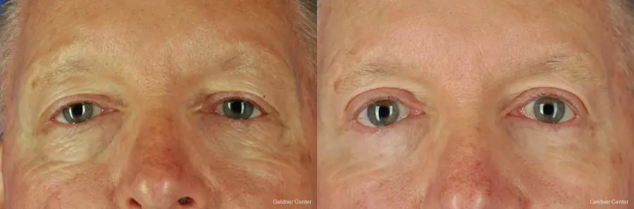 Eyelid-lift-for-men: Patient 1 - Before and After  