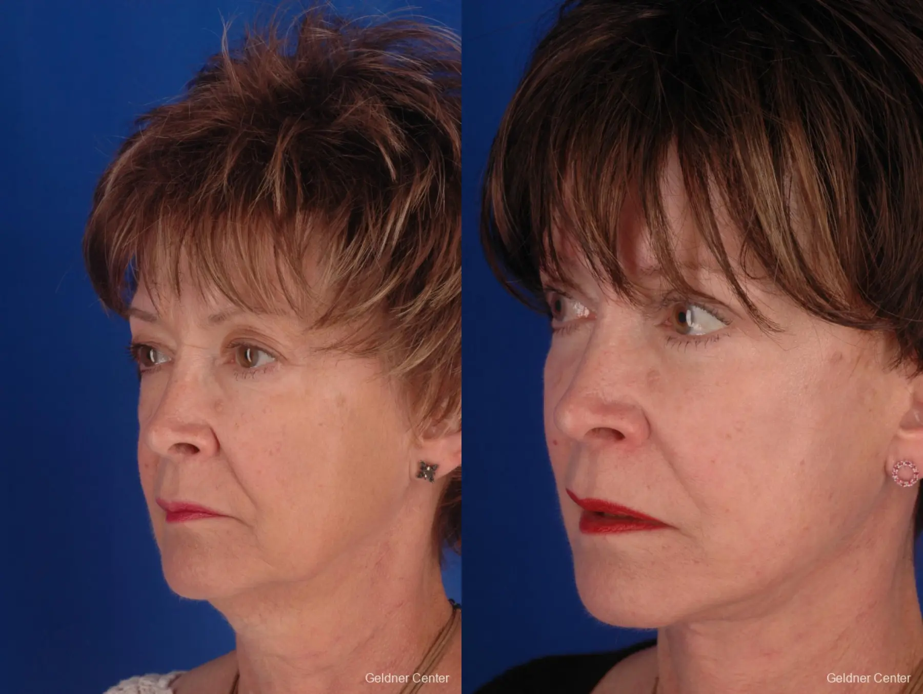 59 year old woman, upper and lower lid blepharoplasty - Before and After 5