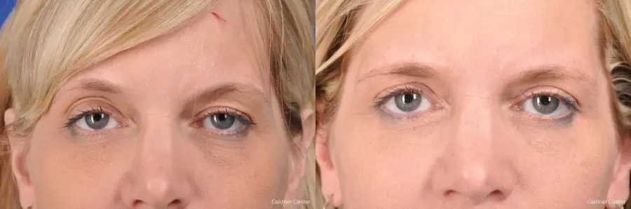 Eyelid Lift: Patient 9 - Before and After  