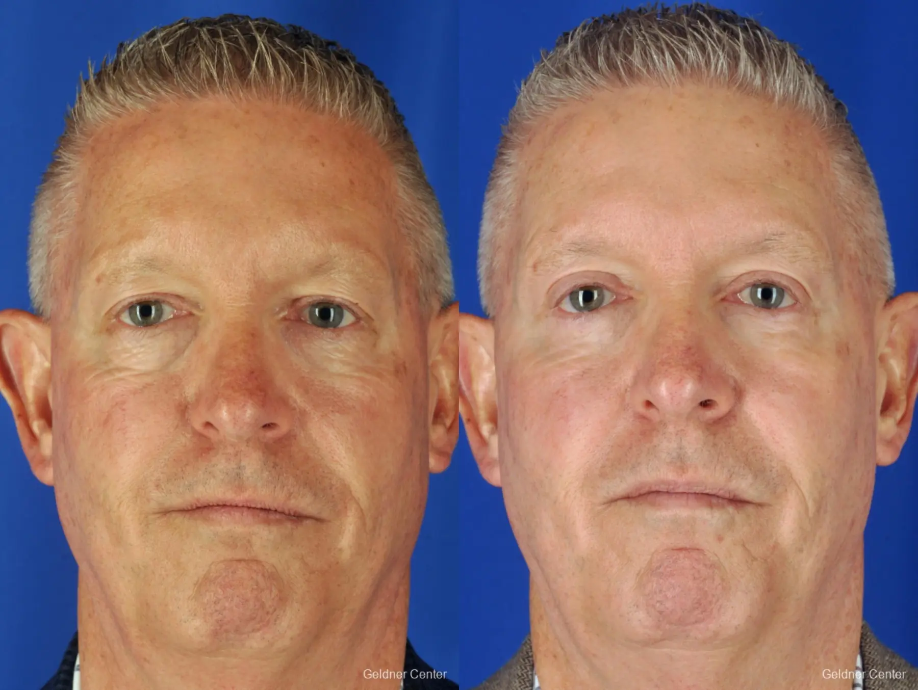 Eyelid Lift For Men: Patient 1 - Before and After 3
