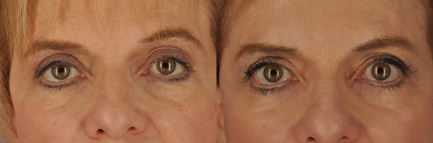 68 year old woman, revision blepharoplasty - Before and After 1