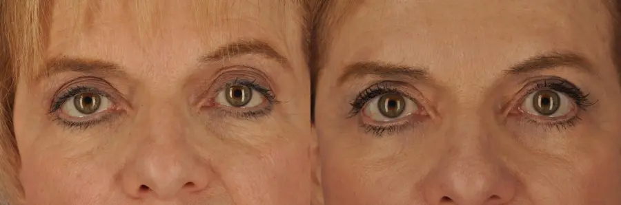 Chicago Eyelid Lift 8744 - Before and After