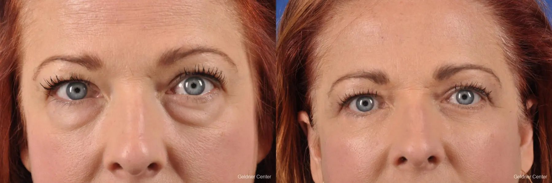 Lower Blepharoplasty with Fat Transposition - Before and After
