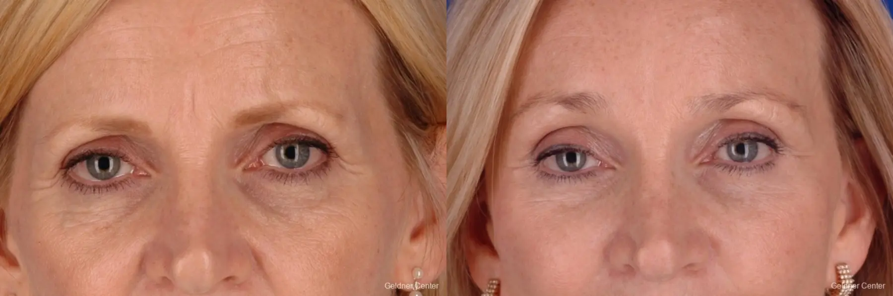 Chicago Eyelid Lift 2287 - Before and After 1