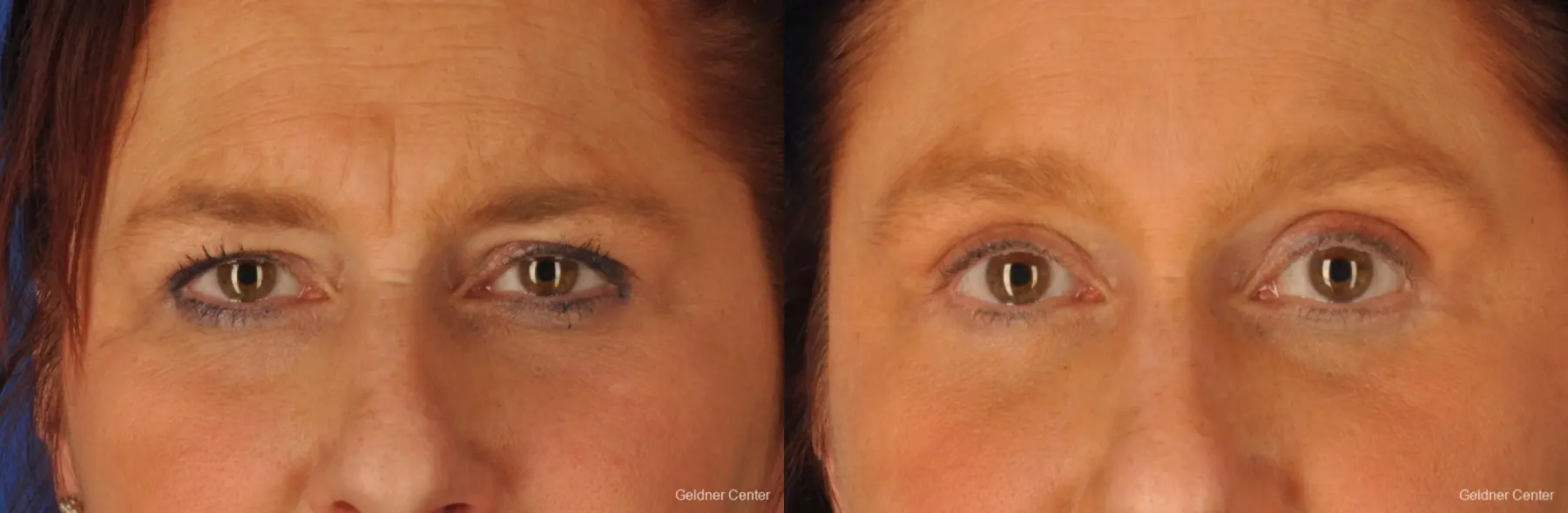 upper and lower blepharoplasty, over 45 - Before and After