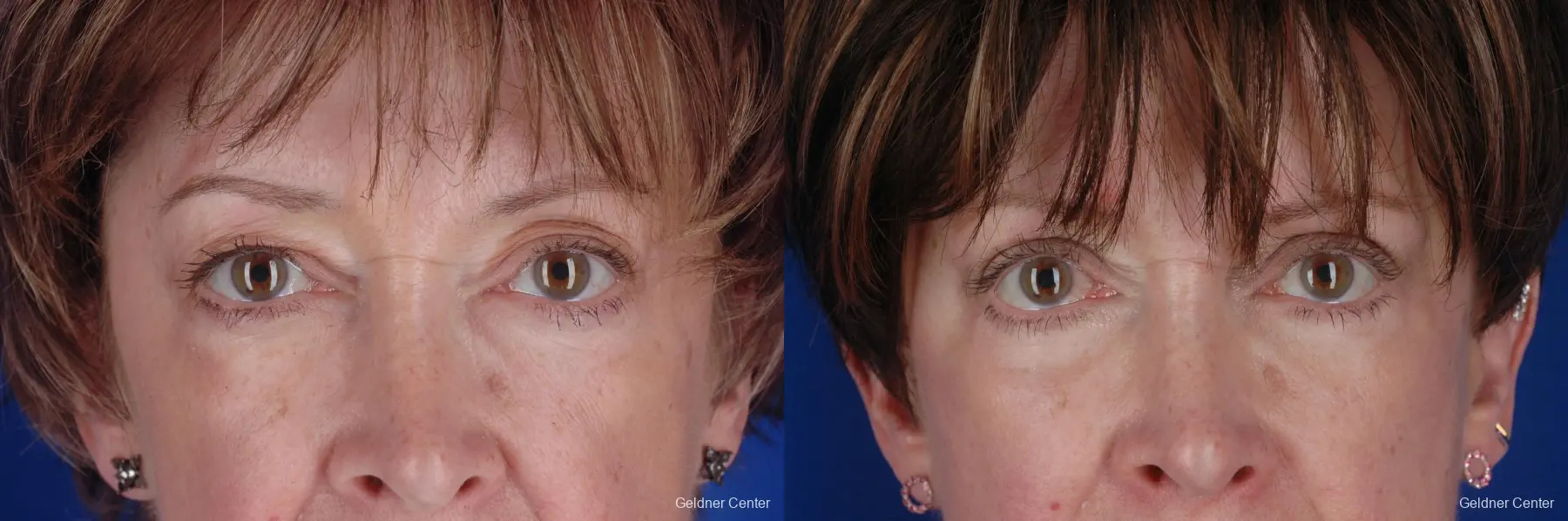 Eyelid Lift Streeterville, Chicago 2396 - Before and After 1