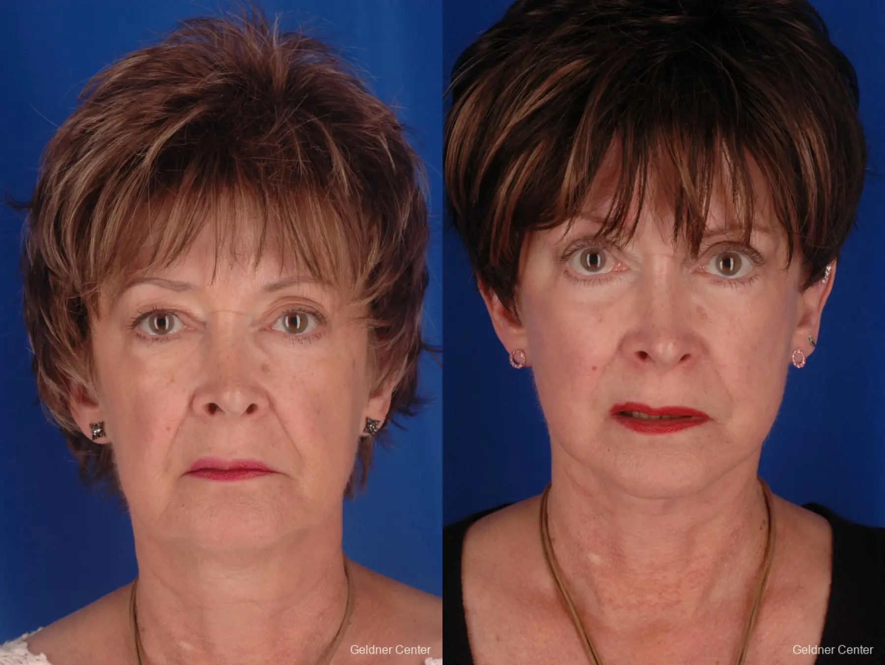 59 year old woman, upper and lower lid blepharoplasty - Before and After 3