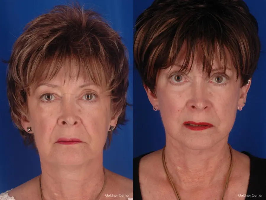 Eyelid Lift Streeterville, Chicago 2396 - Before and After 3