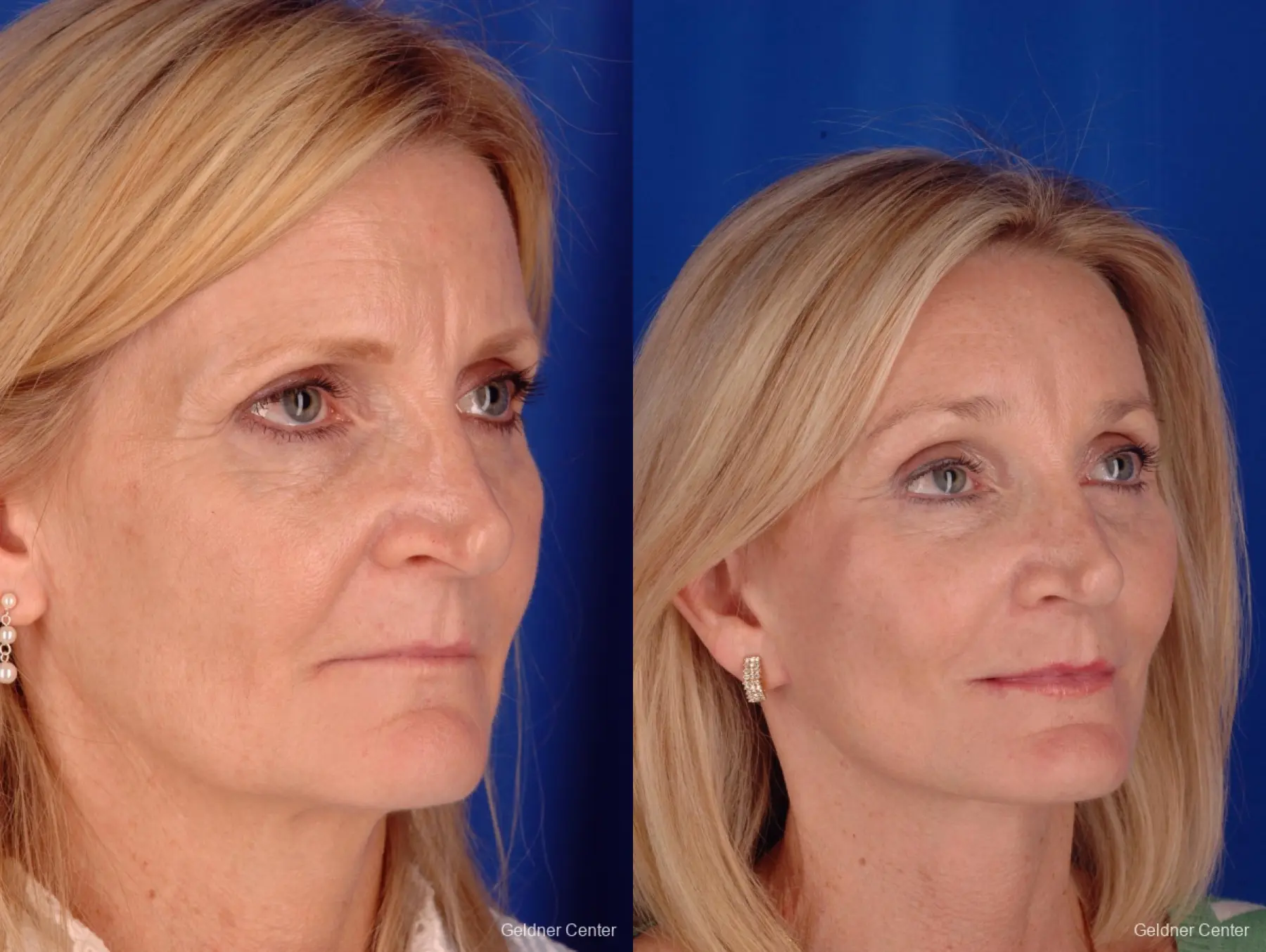 Chicago Eyelid Lift 2287 - Before and After 3
