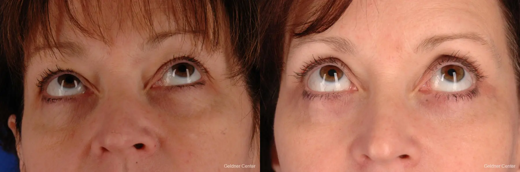 Chicago Eyelid Lift 2323 - Before and After 3