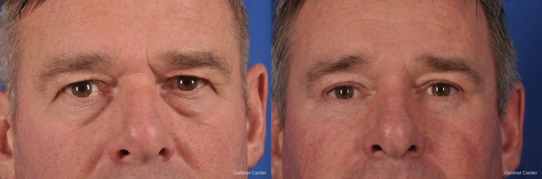 Eyelid-lift-for-men: Patient 1 - Before and After  