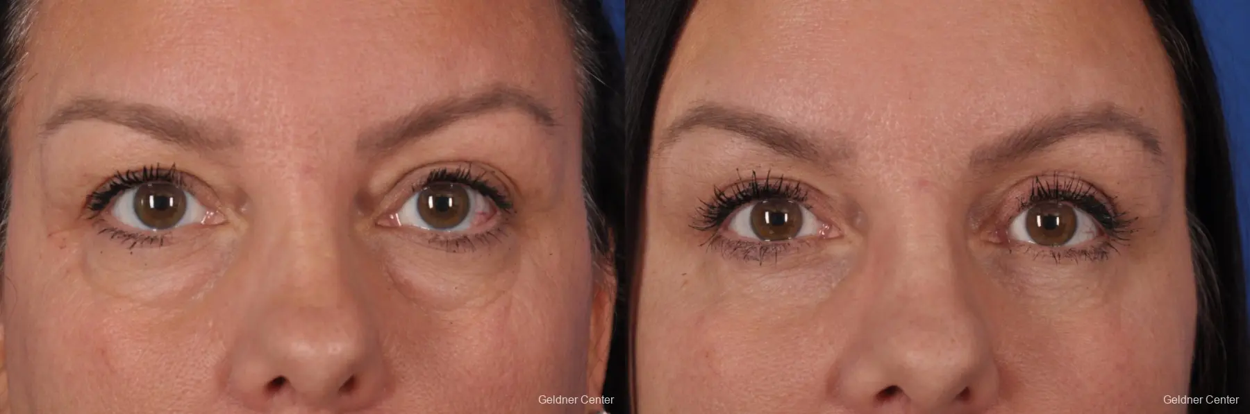Excess Fat and Skin from the Upper Eyelids - Before and After