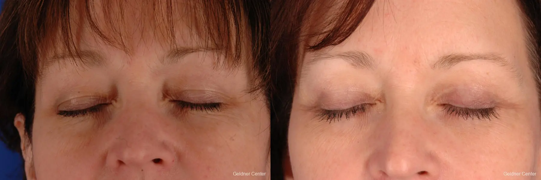 Chicago Eyelid Lift 2323 - Before and After 2