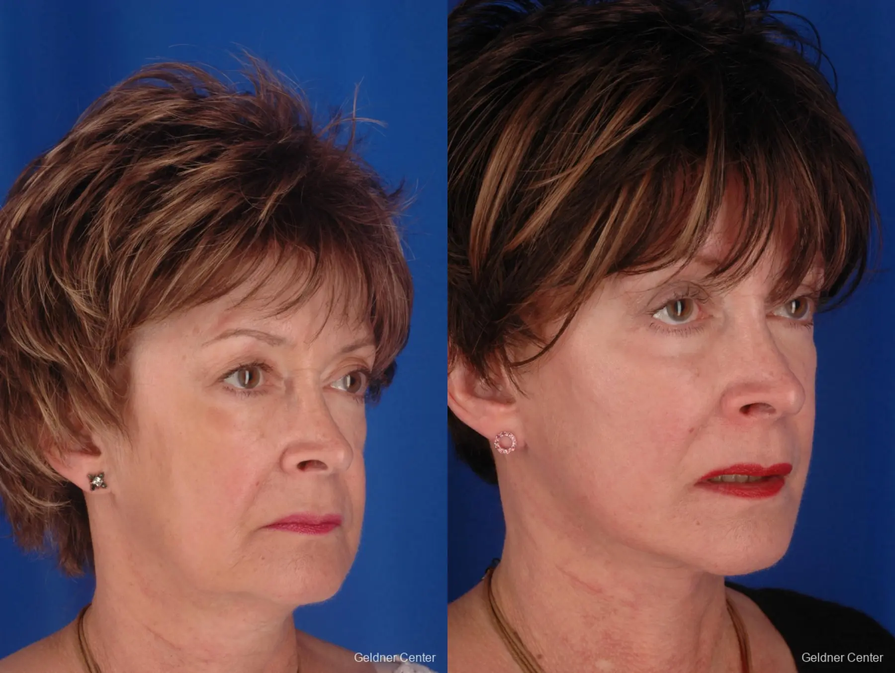 59 year old woman, upper and lower lid blepharoplasty - Before and After 4