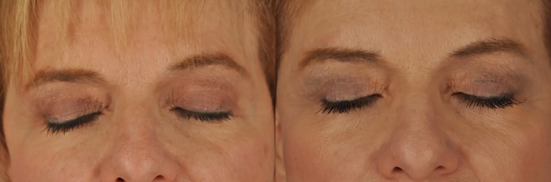 Chicago Eyelid Lift 8744 - Before and After 2
