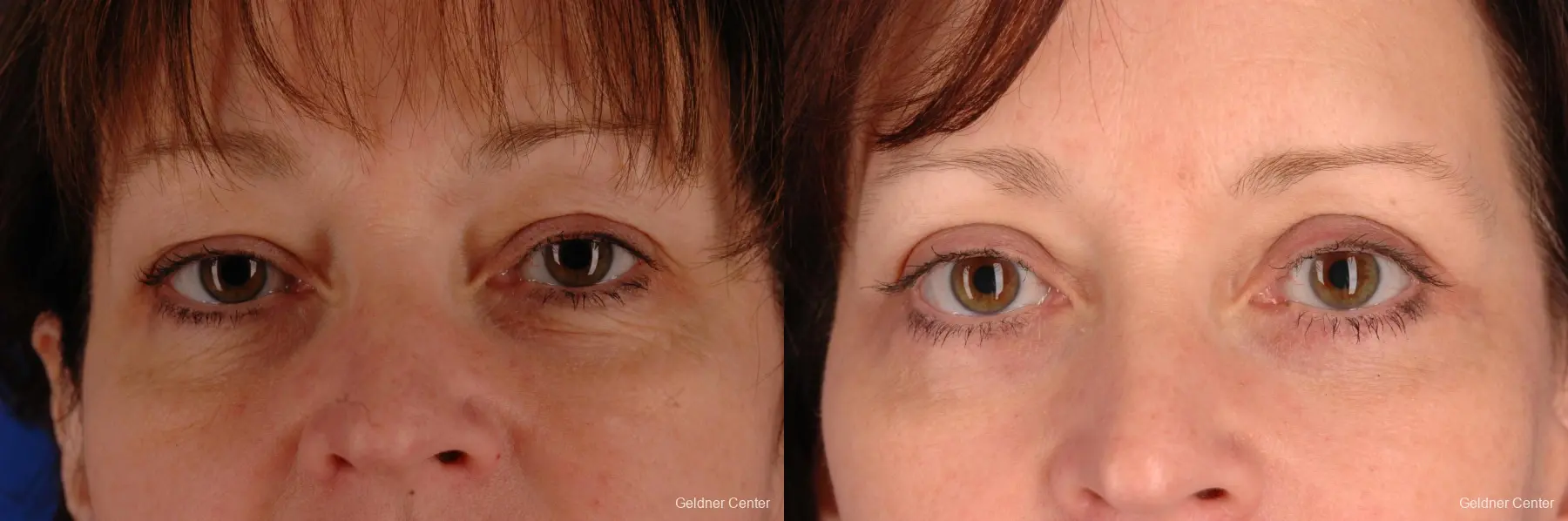 Chicago Eyelid Lift 2323 - Before and After
