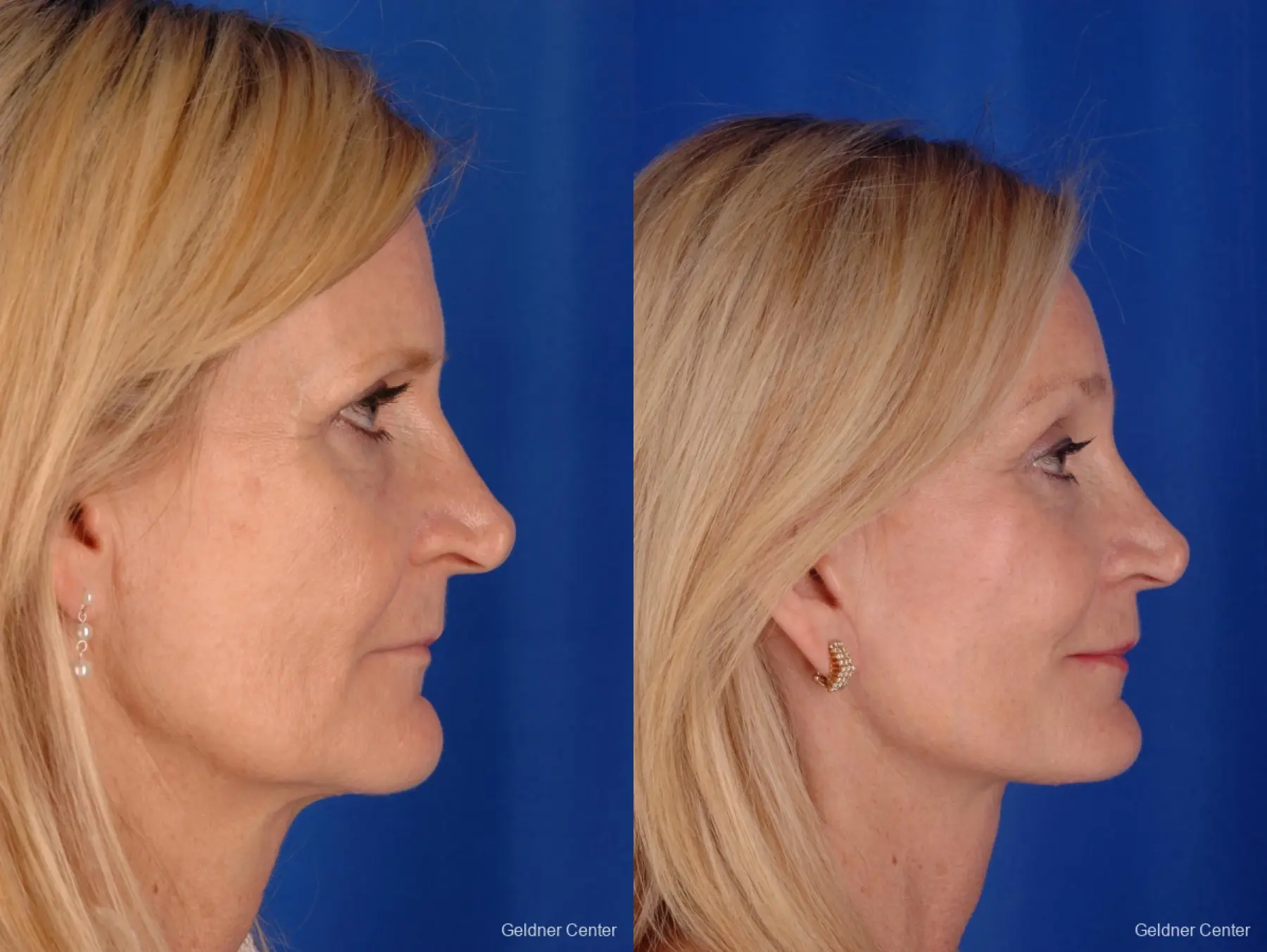Chicago Eyelid Lift 2287 - Before and After 2