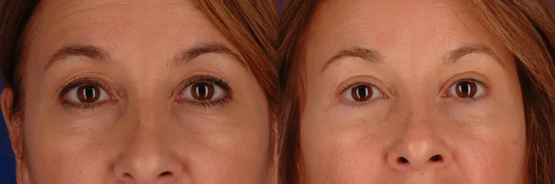 Eyelid Lift Lake Shore Dr, Chicago 2338 - Before and After 1