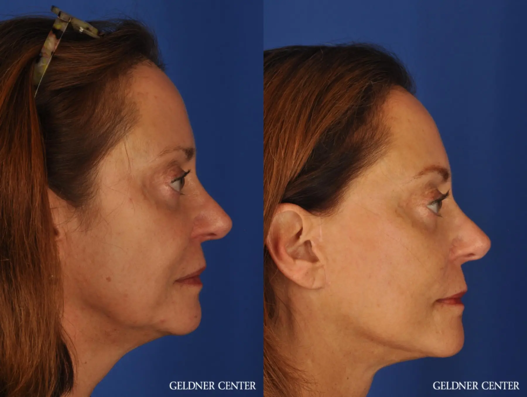 Facelift & Neck Lift: Patient 1 - Before and After 2