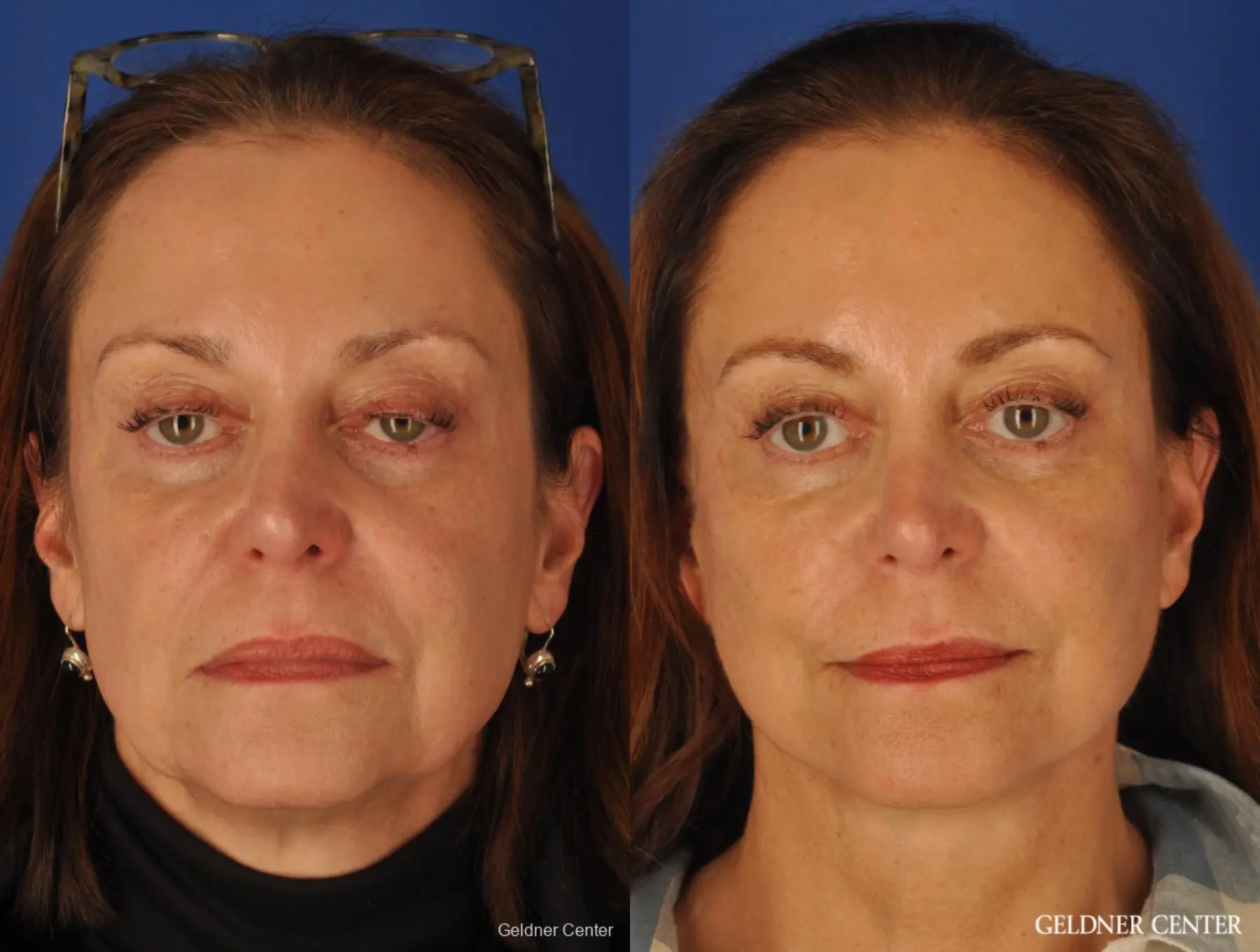 Facelift & Neck Lift: Patient 1 - Before and After  