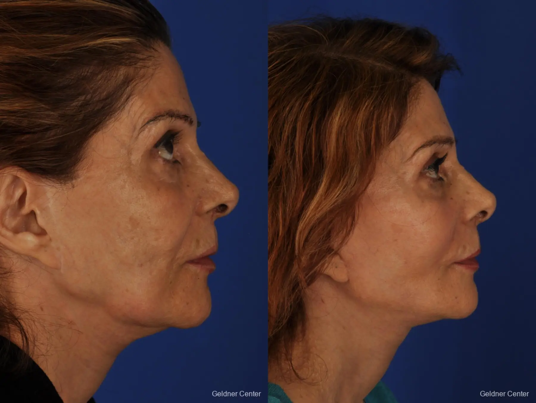 Facelift: Patient 4 - Before and After 2