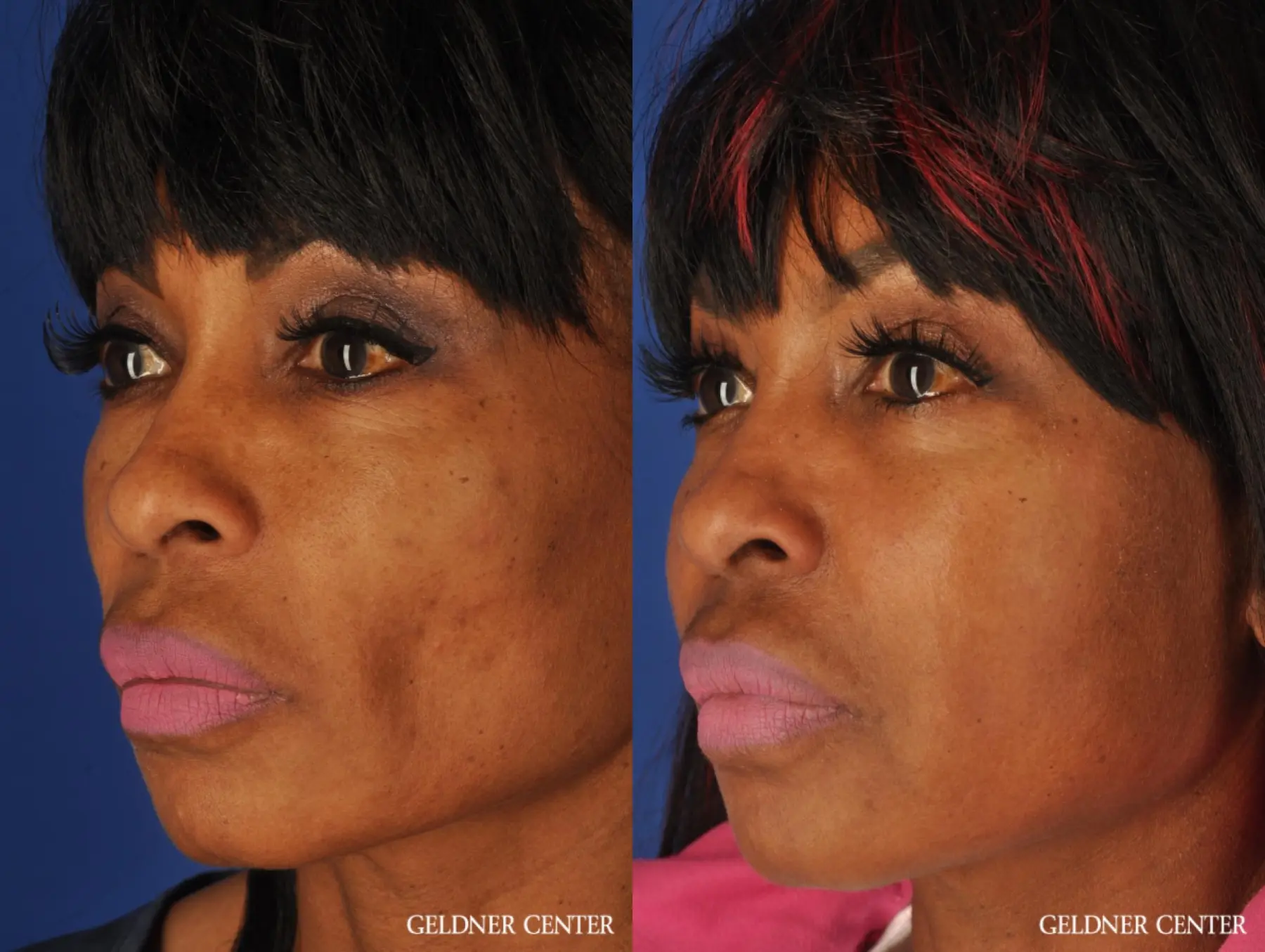 Facelift: Patient 7 - Before and After 5