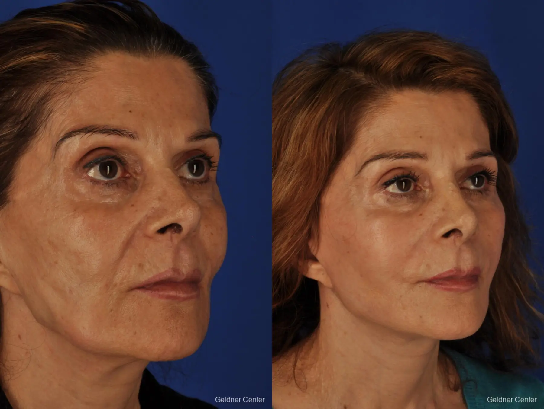Facelift: Patient 4 - Before and After 3