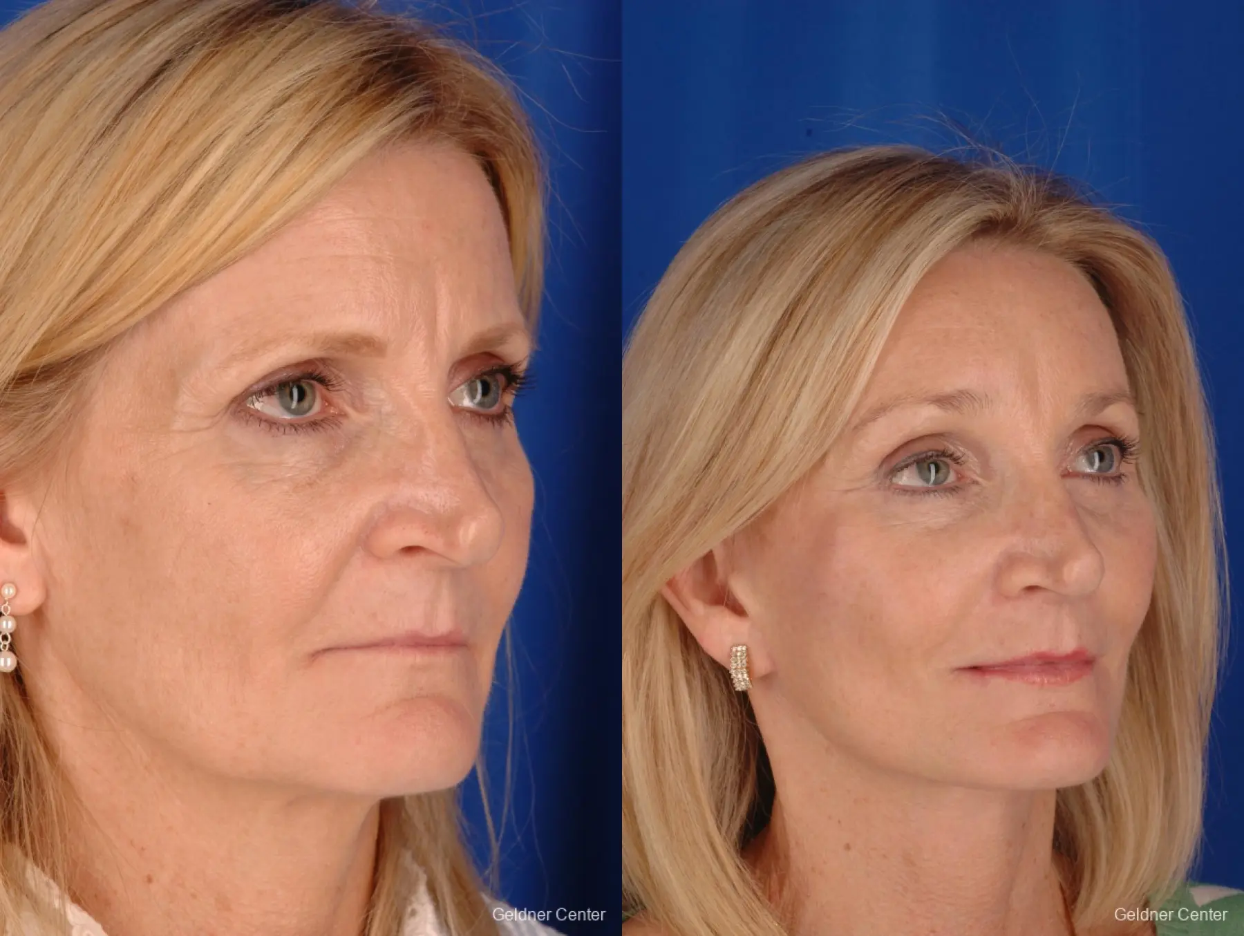 Facelift: Patient 5 - Before and After 4