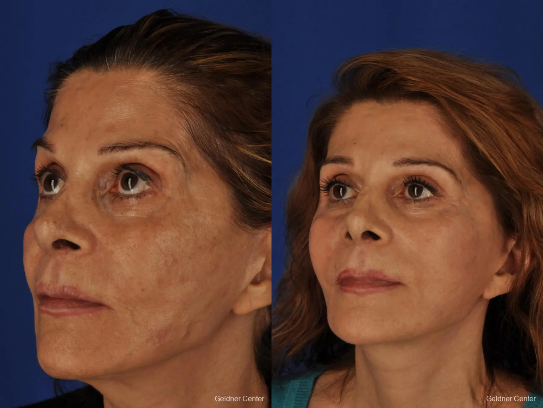 Facelift: Patient 3 - Before and After 4