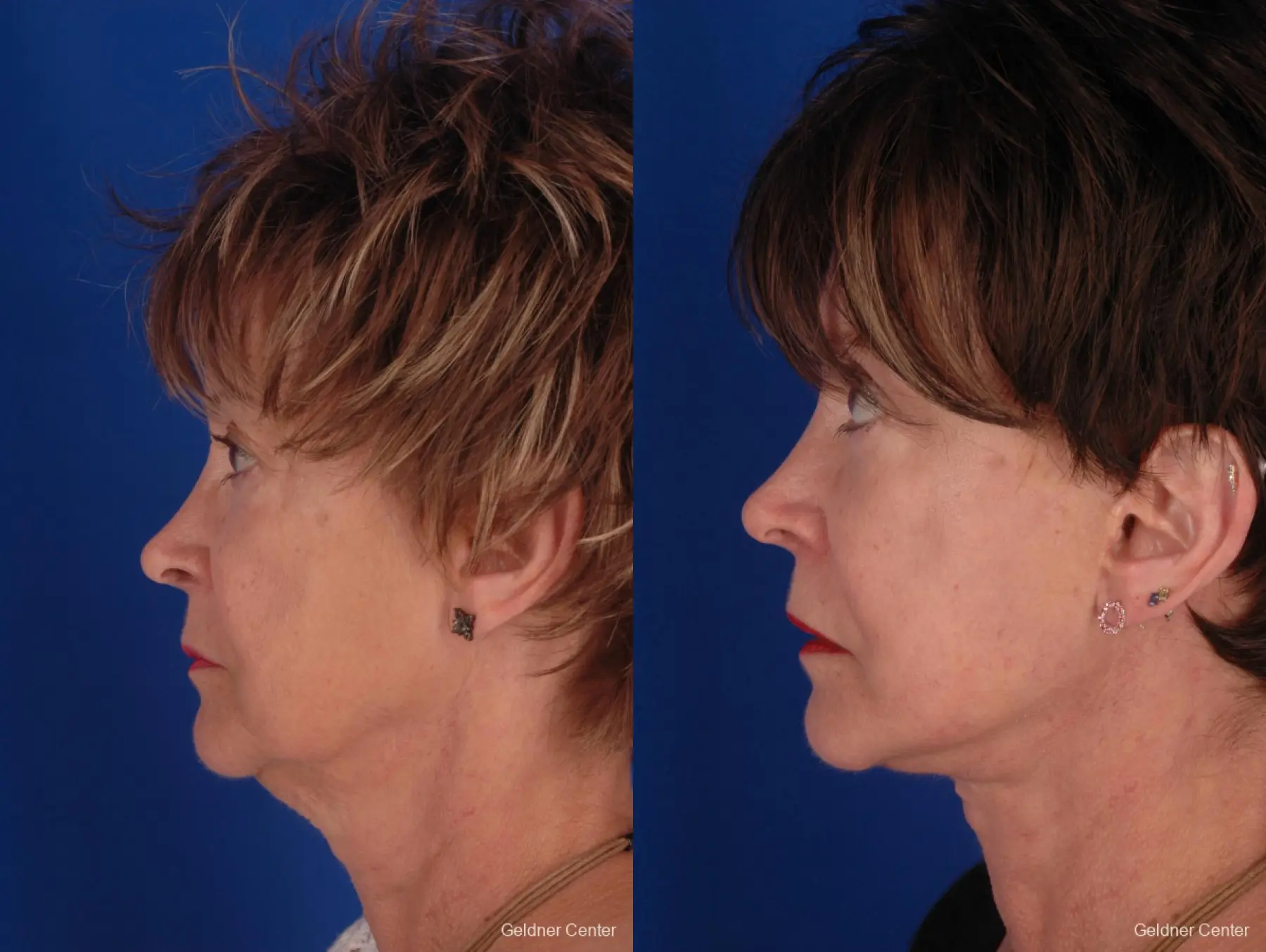 Facelift: Patient 2 - Before and After 4