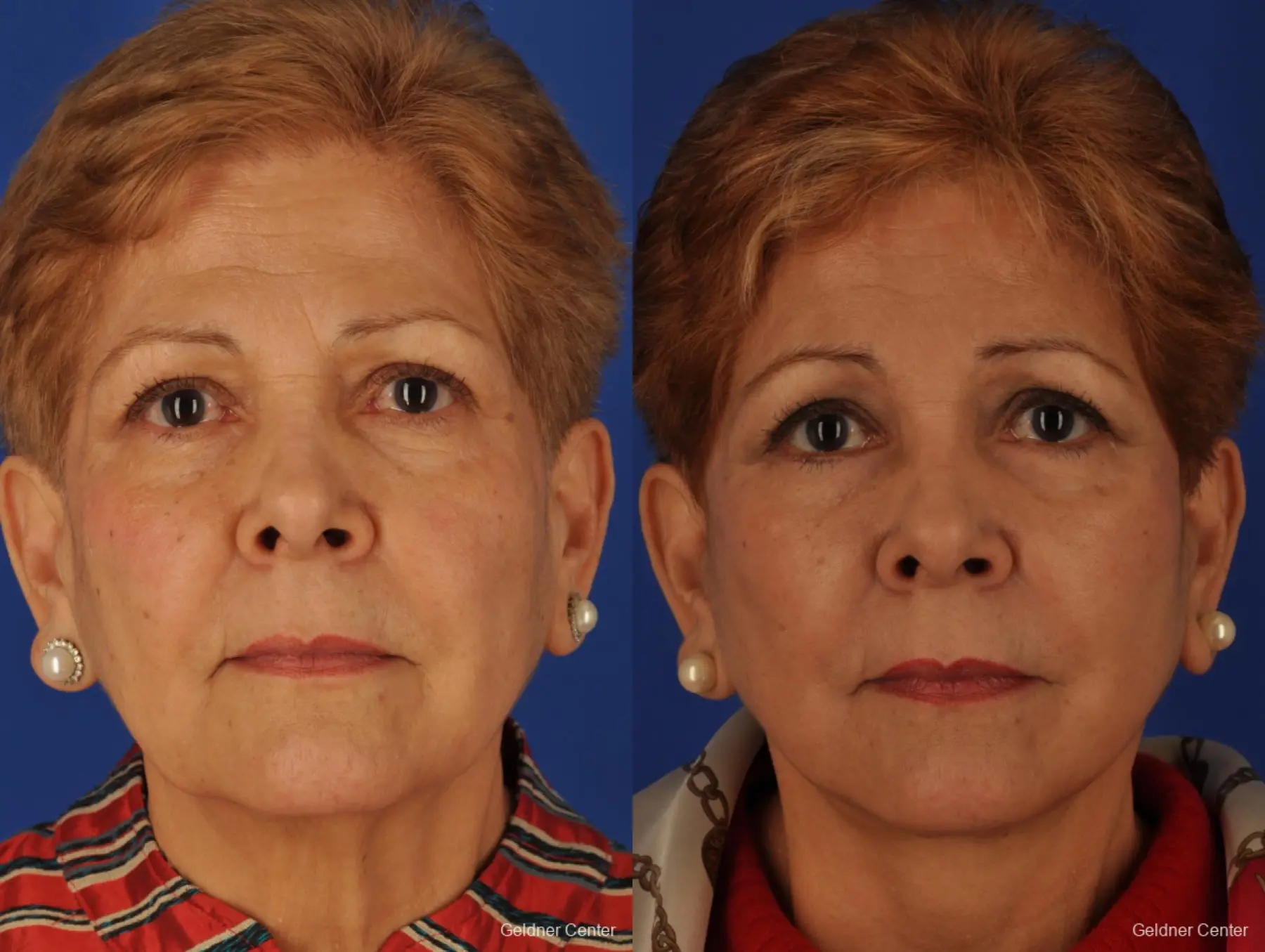SMAS Facelift Chicago - Before and After