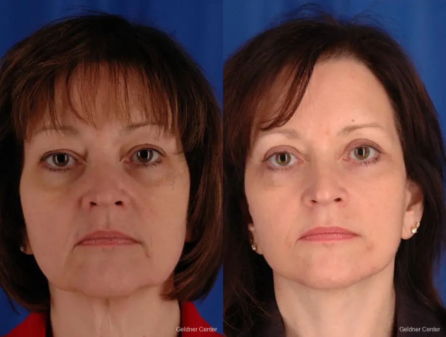Facelift: Patient 1 - Before and After  