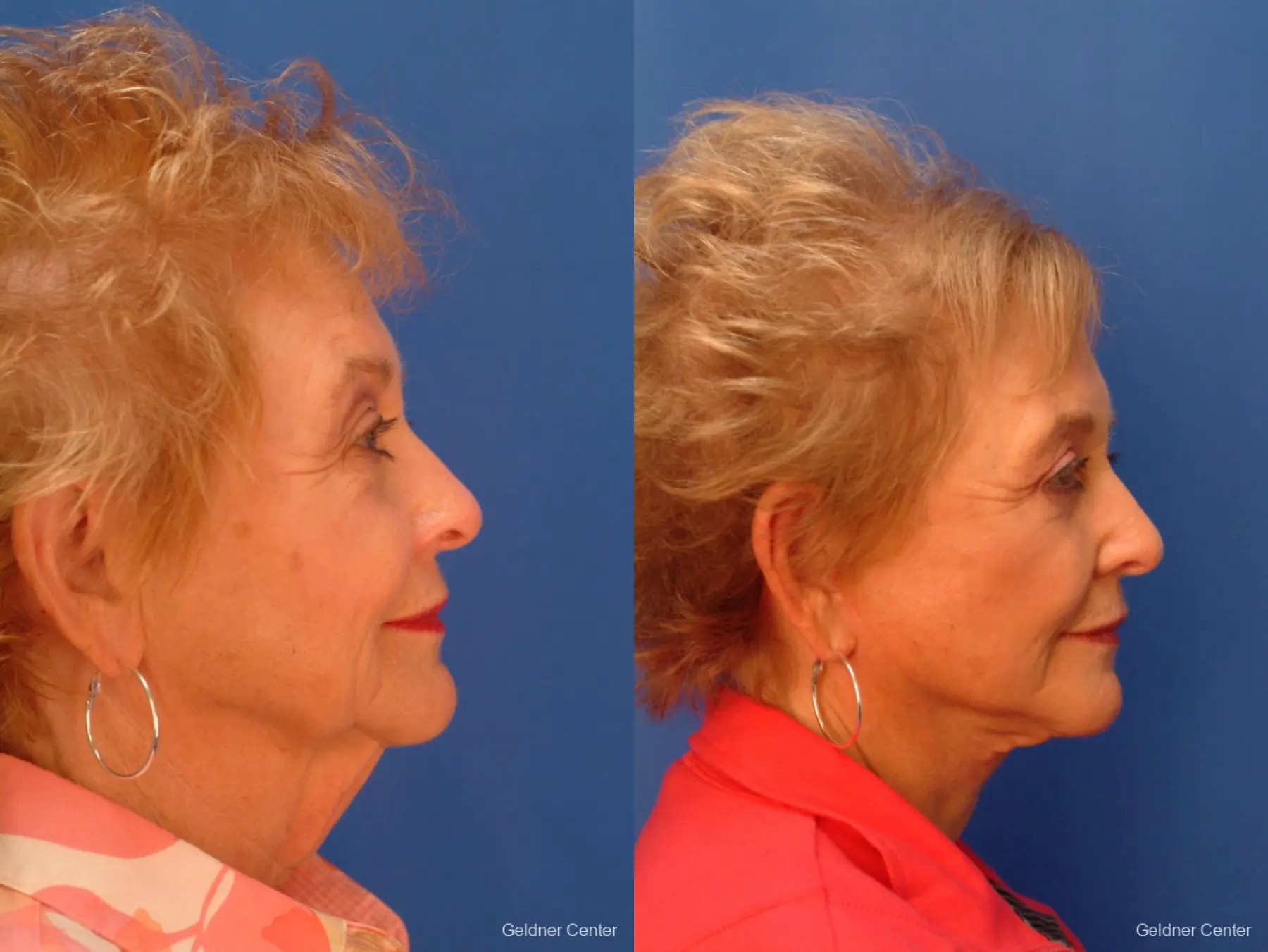 Facelift: Patient 1 - Before and After 2