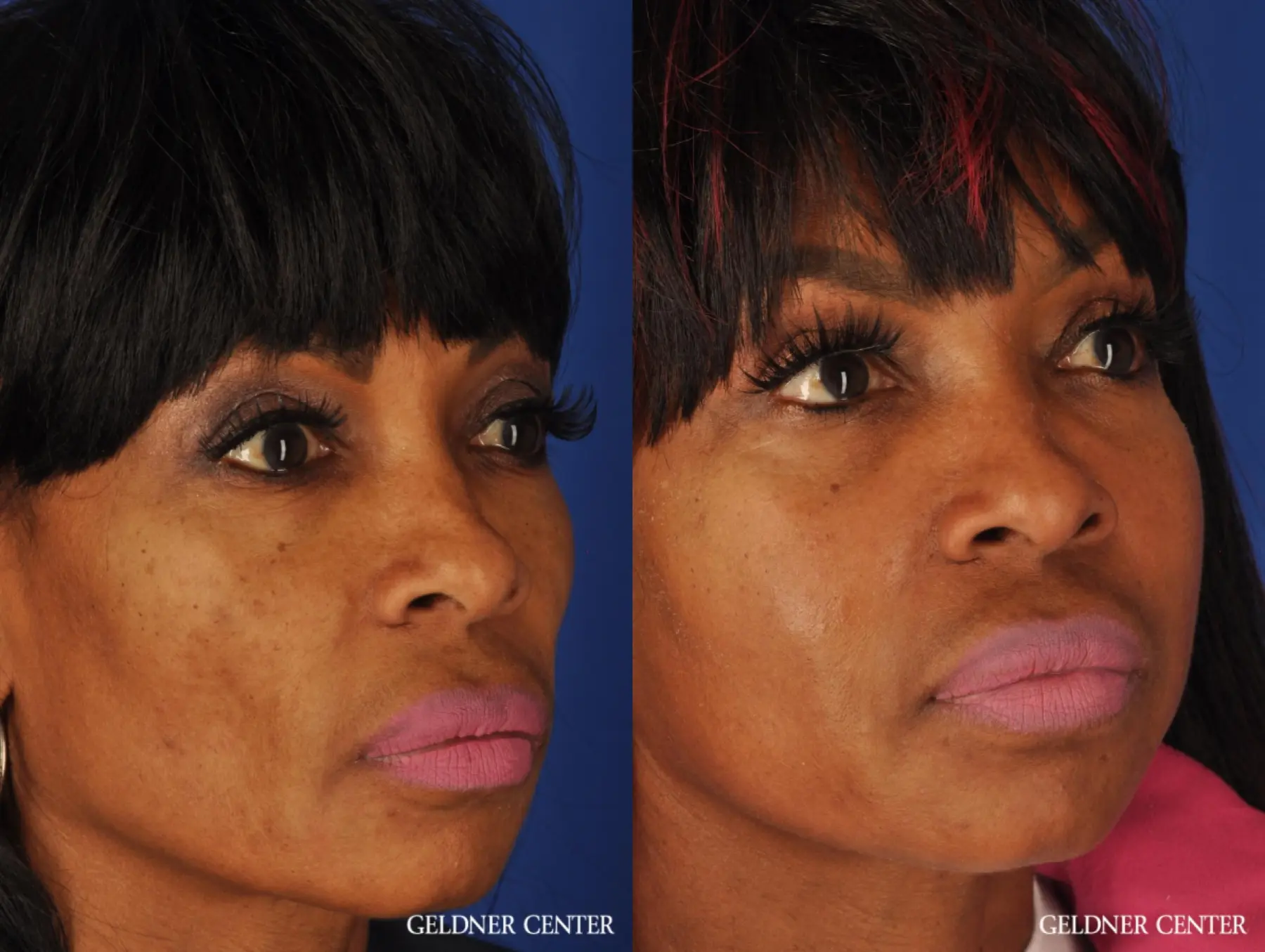 Facelift: Patient 7 - Before and After 4