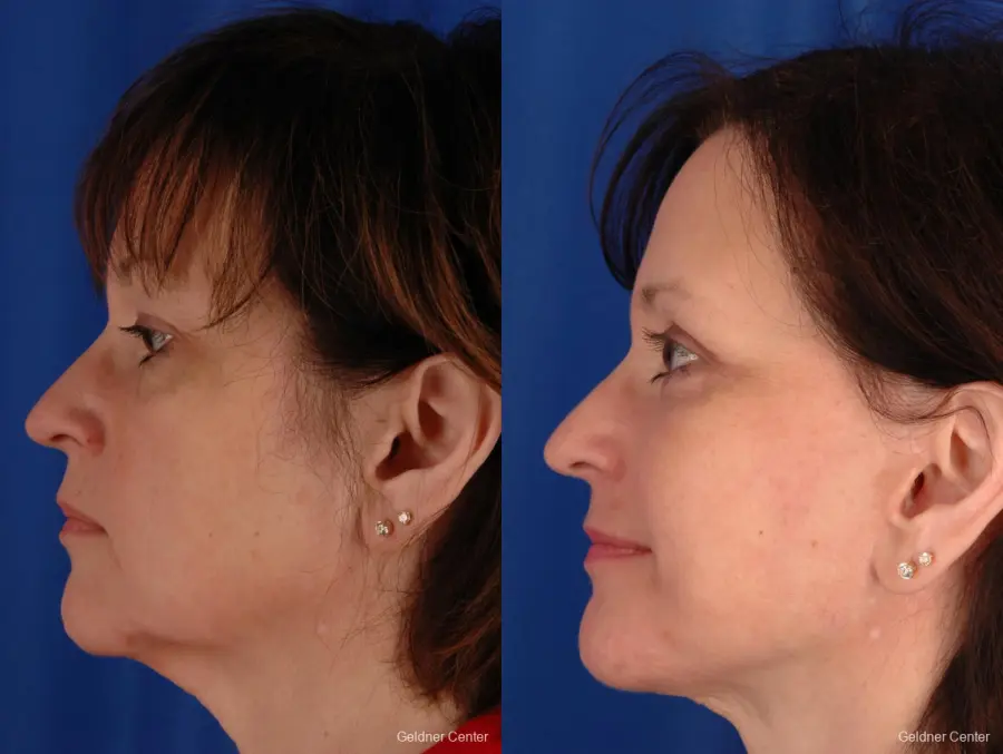 Facelift: Patient 1 - Before and After 4