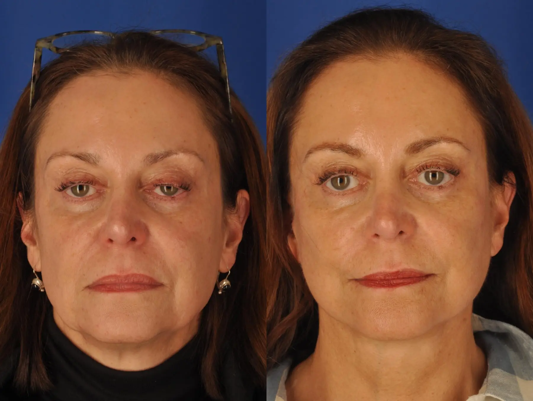 Facelift: Patient 6 - Before and After 1