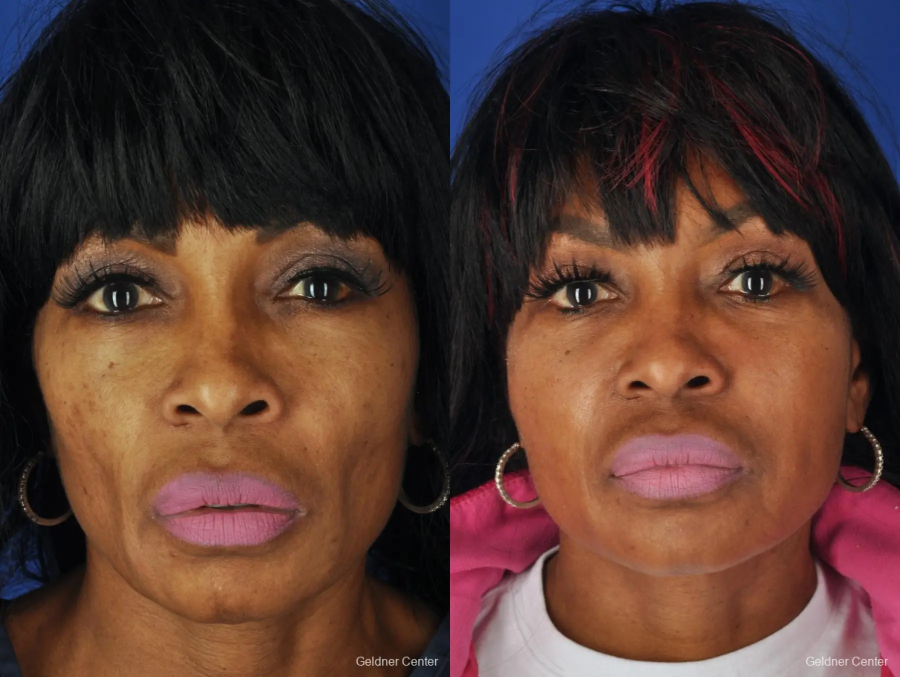 Fat Transfer to Face - Before and After