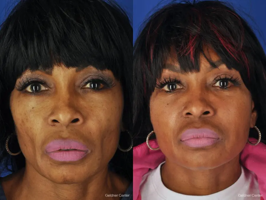 Facelift: Patient 8 - Before and After 1