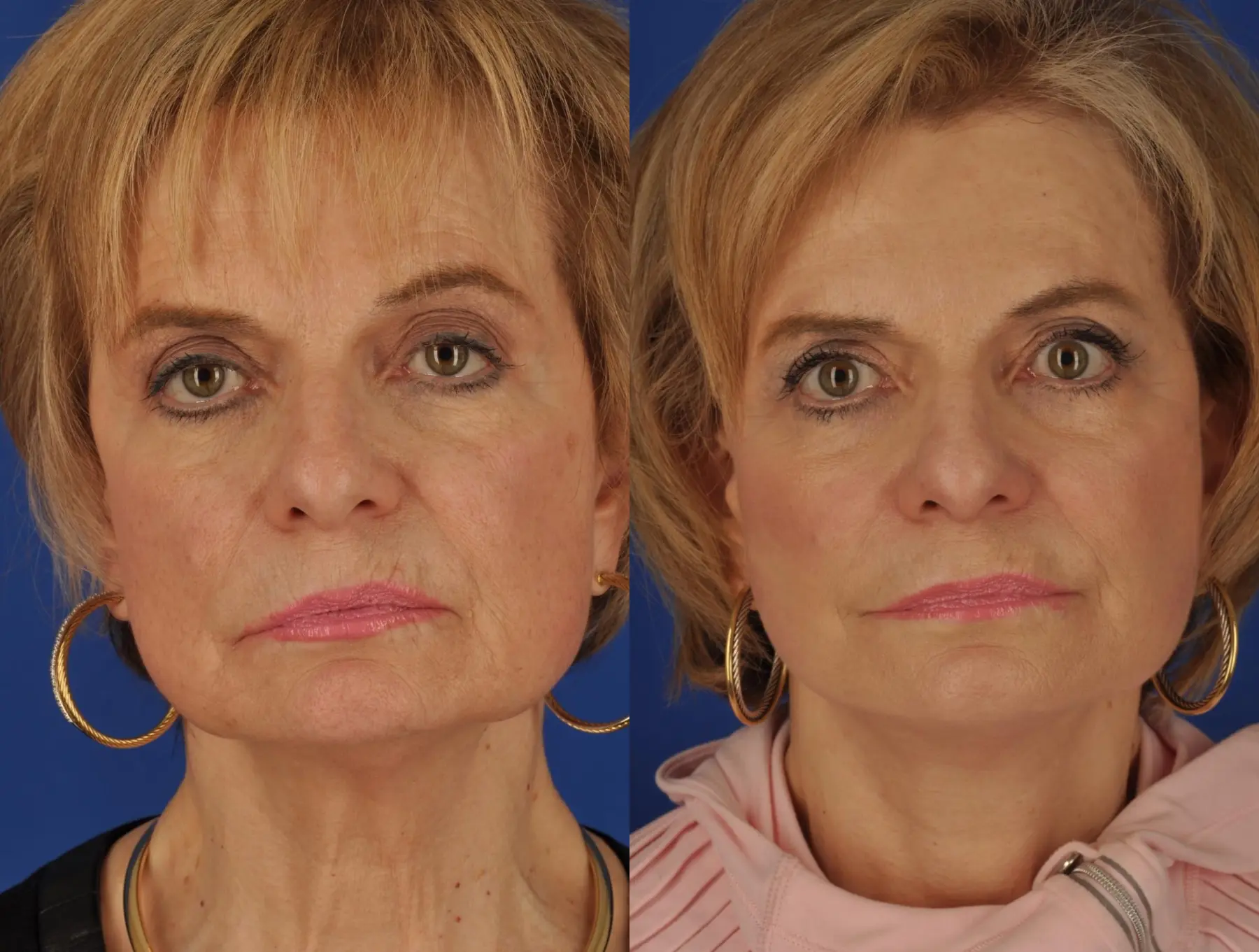 Facelift: Patient 8 - Before and After  