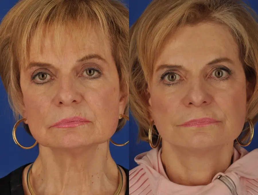 Facelift: Patient 9 - Before and After  