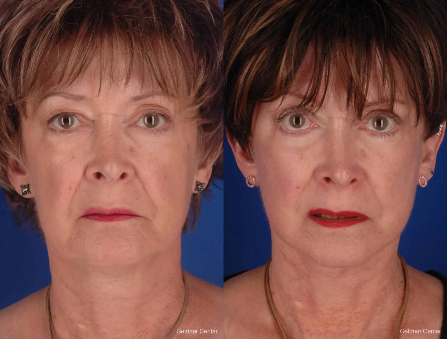 59 year old woman, facelift - Before and After
