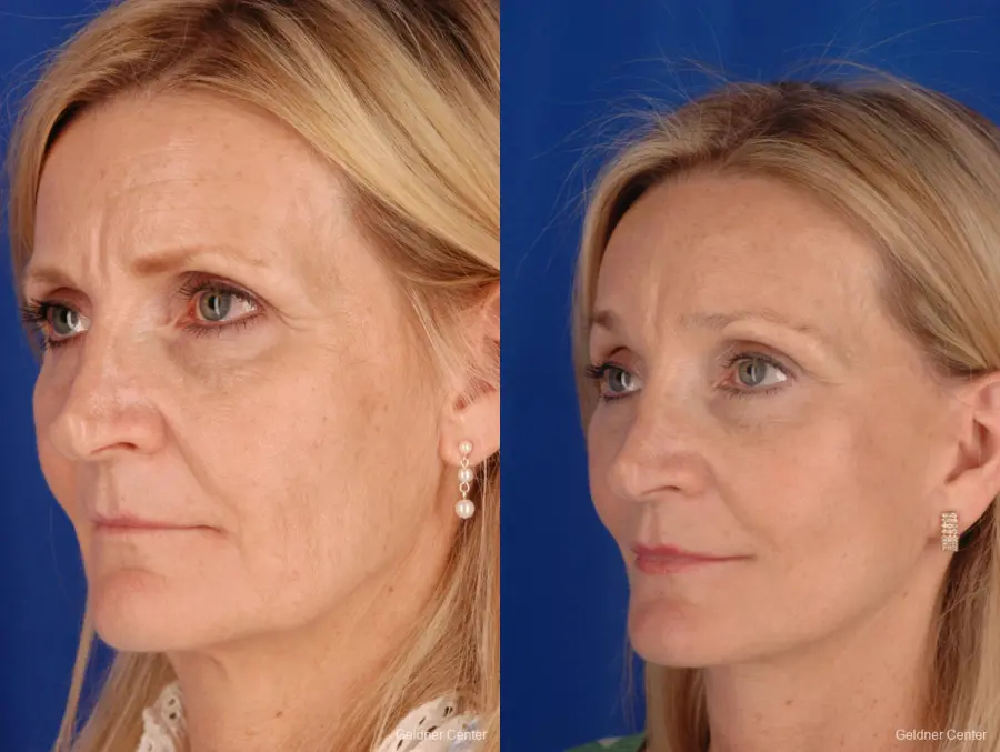 Facelift: Patient 3 - Before and After 5
