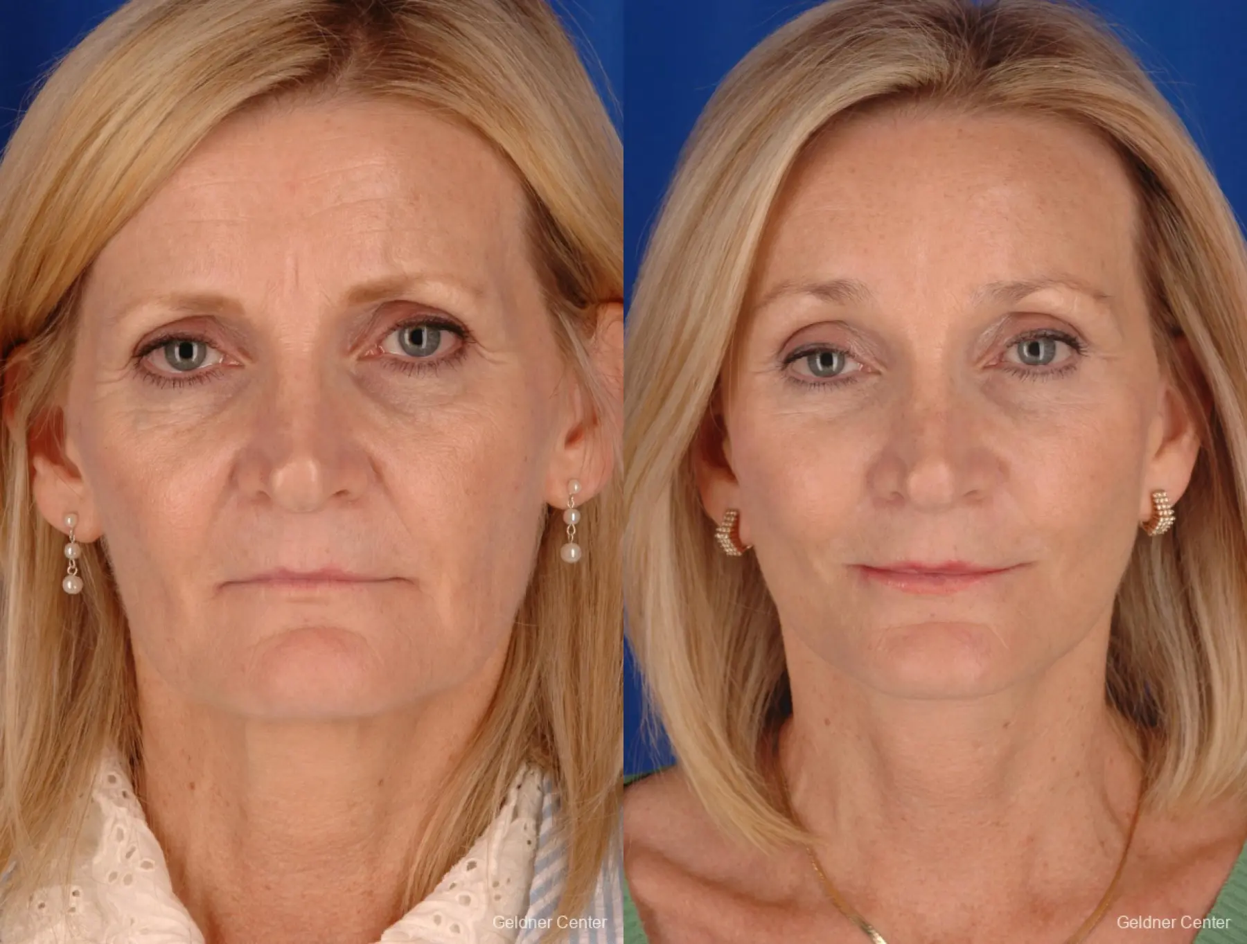 Facelift: Patient 2 - Before and After  