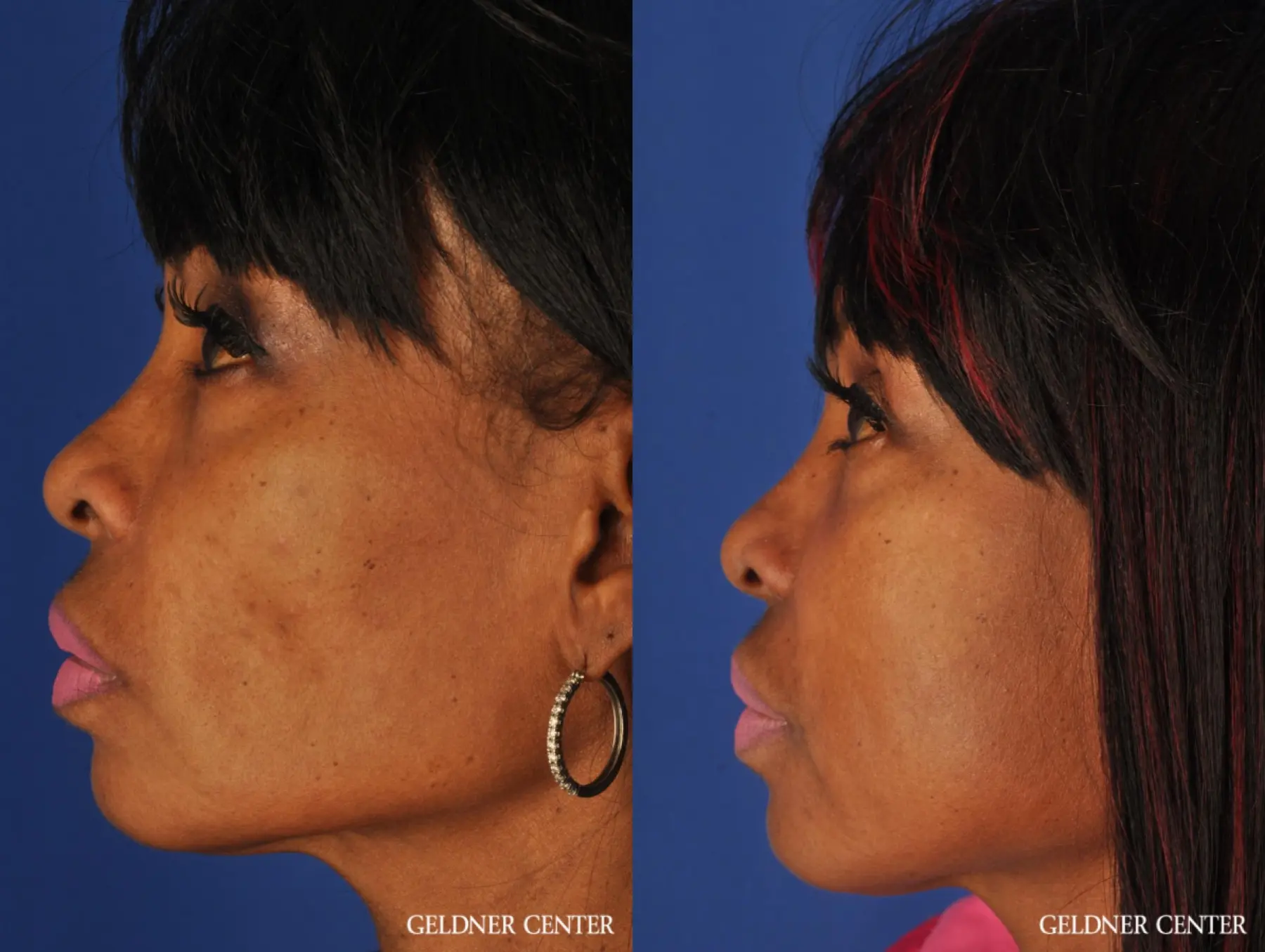 Fat Transfer to Face - Before and After 3